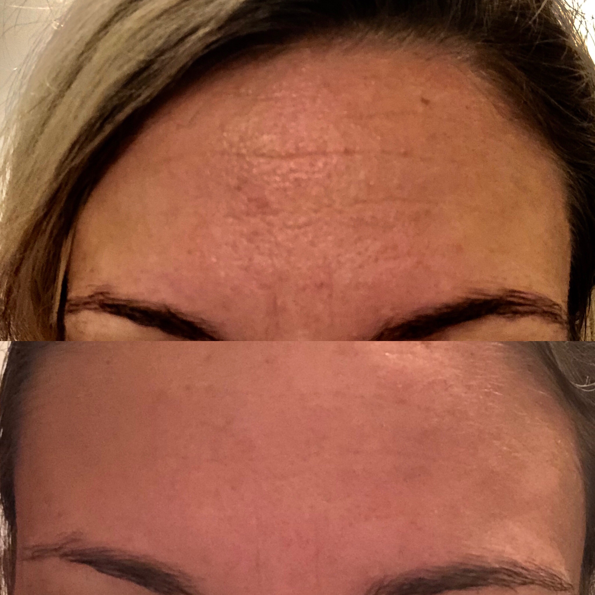 microneedling